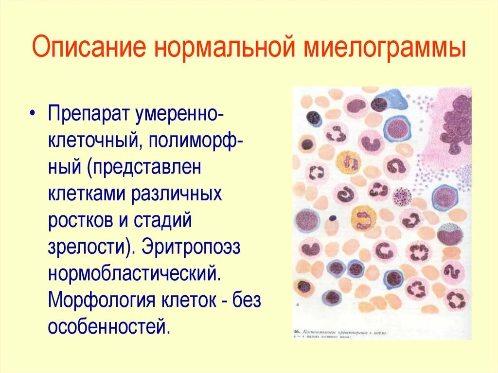 Результаты костного мозга. Костный мозг микроскопия. Миелограммы при остром лейкозе. Миелограмма норма лимфоциты.