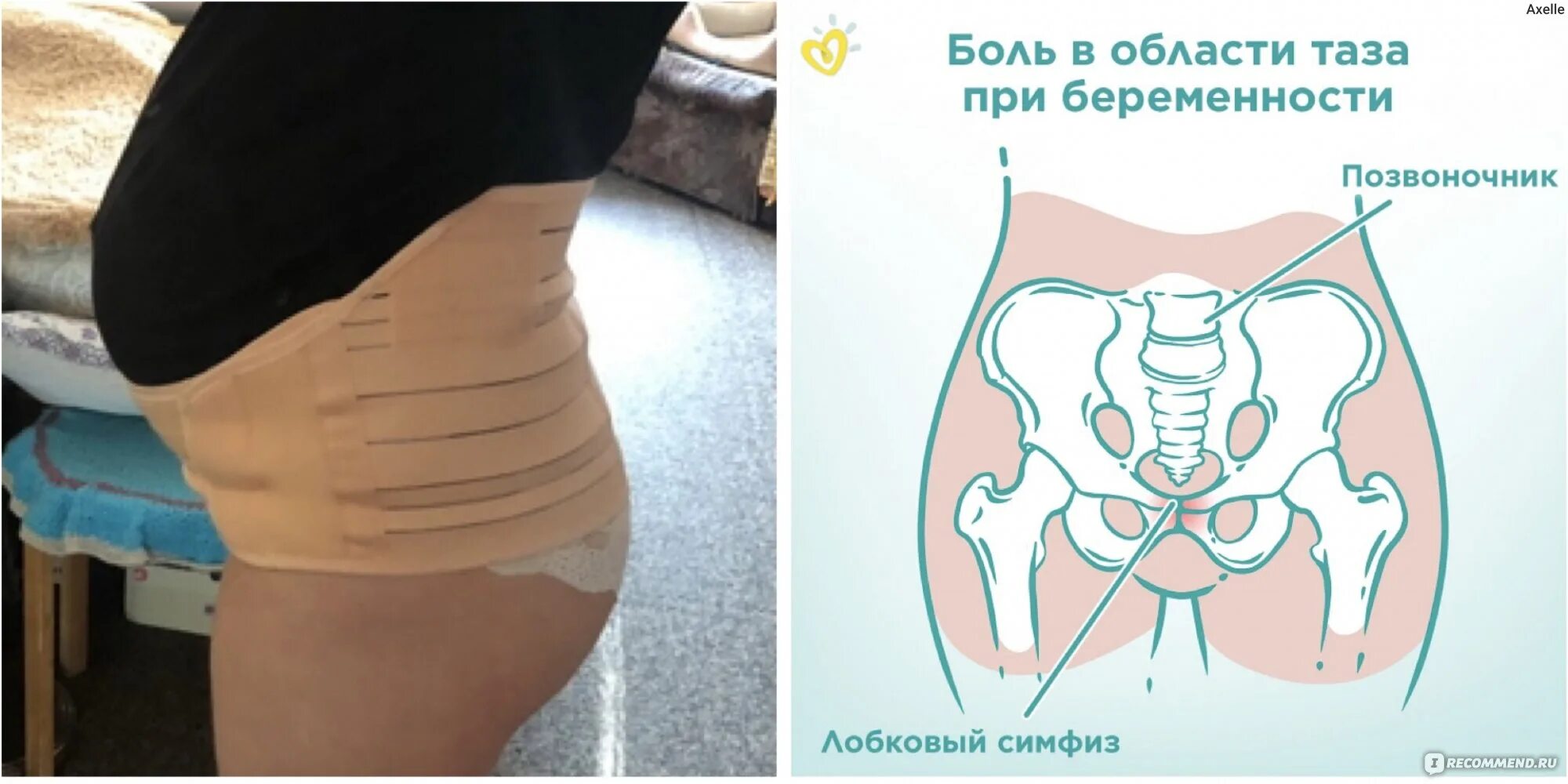 Симфизит при беременности что. Симфизит при беременности. узи лобкового симфиза при симфизите. лонное сочленение при беременности.