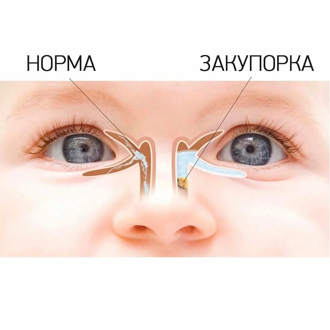 Массаж глаз слезного канала. Дакриоцистит новорожденных. Непроходимость слезного канала. Непроходимость носослезного канала.