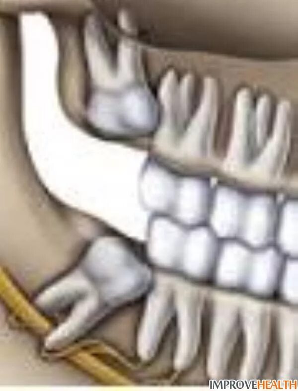 Зуб мудрости (3-й моляр, восьмерка). Дистопированный зуб мудрости верхний. Зуб мудрости корни восьмеркой. Зуб 8 корень