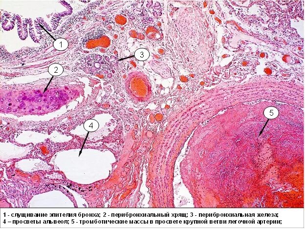 Тромб патологическая анатомия. Смешанный тромб в Вене микропрепарат. Смешанный тромб артерии микропрепарат. Организация тромба