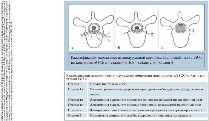 Компрессия дурального мешка что это. Дуральный мешок позвоночника кт. сдавление дурального мешка. компрессия дурального мешка. компрессия дурального мешка поясничного отдела.