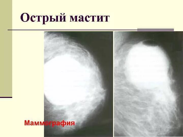 Мастит молочной железы на маммографии. Инфильтративно Гнойный мастит. Мастит нелактационный маммография. Плазмоклеточный мастит на маммографии.