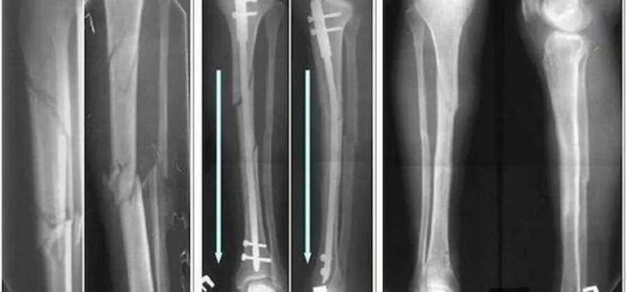 Костная мозоль при переломе.берцовой кости. Реабилитация перелома малой малой берцовой. Костная мозоль после перелома большеберцовой кости на рентгене. Сросшийся перелом берцовой кости.