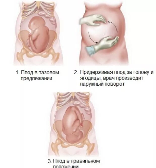 Положение плода в животе. Ягодичное предлежание плода на 34 недели беременности. Тазовое ягодичное предлежание плода 34 недели беременности. Беременность 32-33 недели тазовое предлежание плода. Тазовое предлежание плода на 33 неделе беременности.