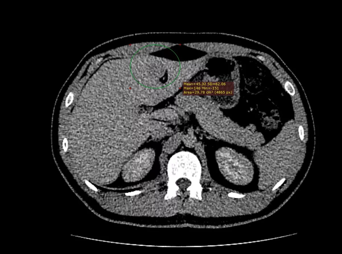 Образования печени кт