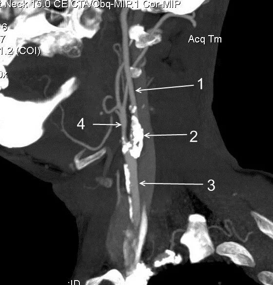 Критический стеноз ВСА. Сегменты ВСА на кт. Сужение шейных сосудов