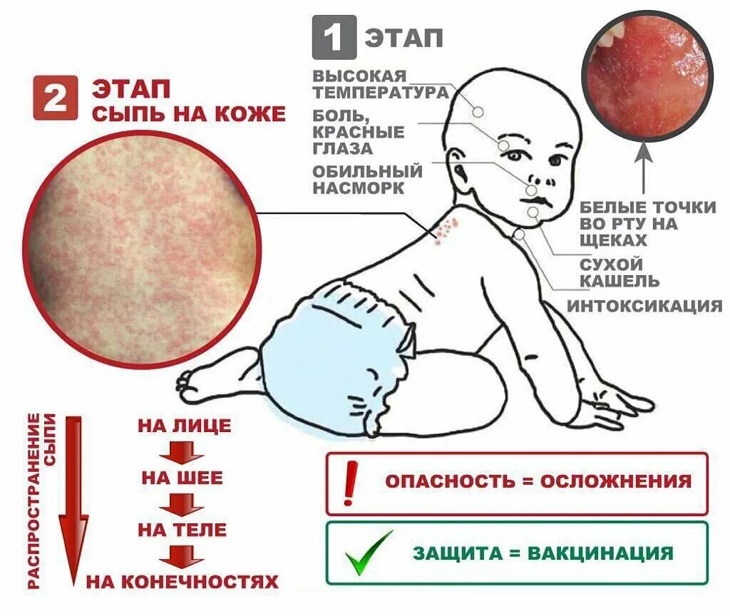 Как распознать корь у ребенка. Как распознать корь у ребенка