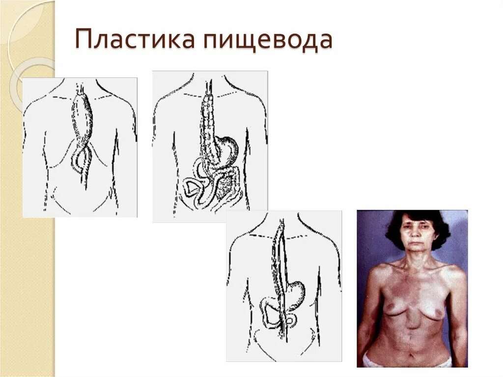 Искусственный пищевод. Пластика пищевода по ру Герцена Юдина. Эзофагопластика пищевода желудком. Тонкокишечная эзофагопластика по методу ру Герцена Юдина. Пластика пищевода по Юдину.