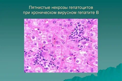 Некроз печени