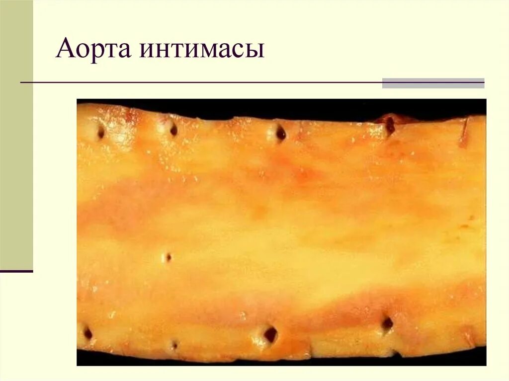 Атеросклероз аорты стадии. Атеросклероз аорты макропрепарат. атеросклероз аорты патанатомия. атеросклероз аорты стадия бляшек макропрепарат. атеросклероз жировая полоска.