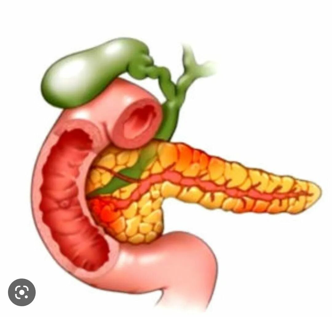 Острый панкреатит врач. Хронический панкреатит. Вирсунголитиаз хронический панкреатит. Хронический панкреатит рисунок.