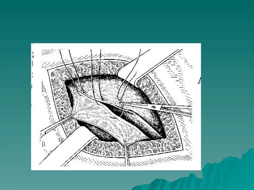 Пластика грыжи жирару спасокукоцкому. Пластика пахового канала по краснобаеву. Пластики пахового канала по бассини. Пластика передней стенки по жирару-спасокукоцкому. Пластинка передней стенки пахового канала по.