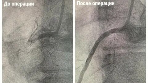 Тромб после инфаркта
