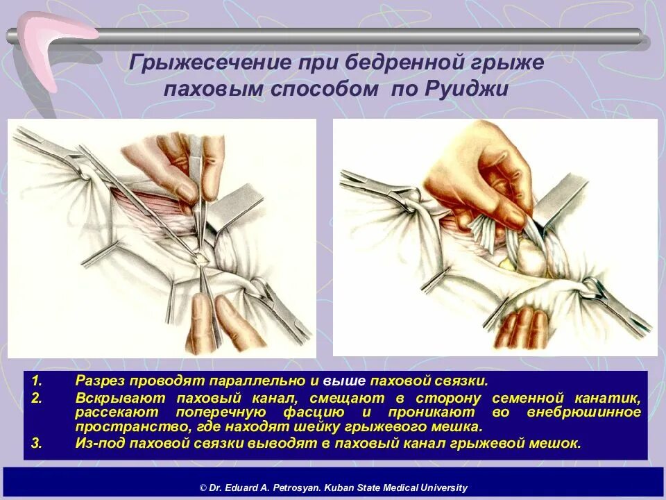 Грыжесечение бедренной грыжи. Операции при бедренной грыжи паховым и бедренным способом. Операция – грыжесечение по Руджи. Операция грыжесечение ущемленной грыжи. Цена лечения паховых грыж