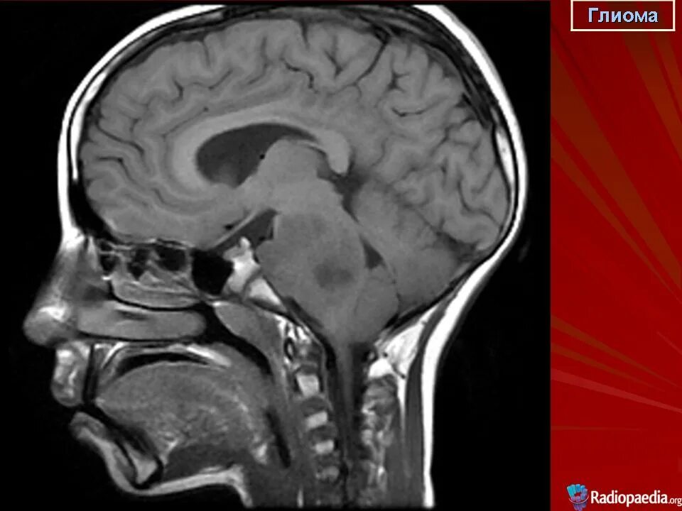 Диффузная глиома ствола головного мозга. Томография глиомы головного мозга. Глиома головного ствола