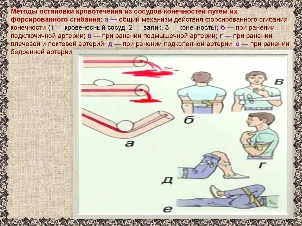 Остановка кровотечения путем сгибания конечности. Способы остановки кровотечения. Методы остановки кровотечений из артерий. Кровотечение методы остановки кровотечения. Способы остановки кровотечения при ранении.