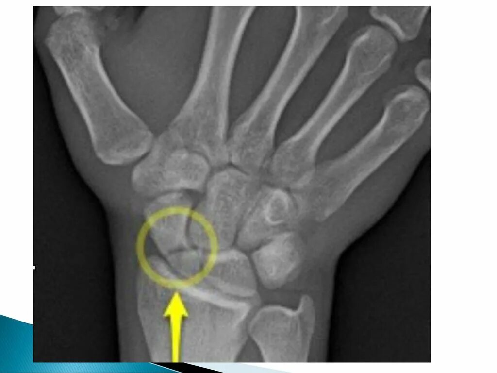 Перелом ладьевидной кости запястья рентген. Перелом ладьевидной кости рентген. Краевой перелом,ладьевидной кости запястья. Ладьевидная кость кисти рентген.