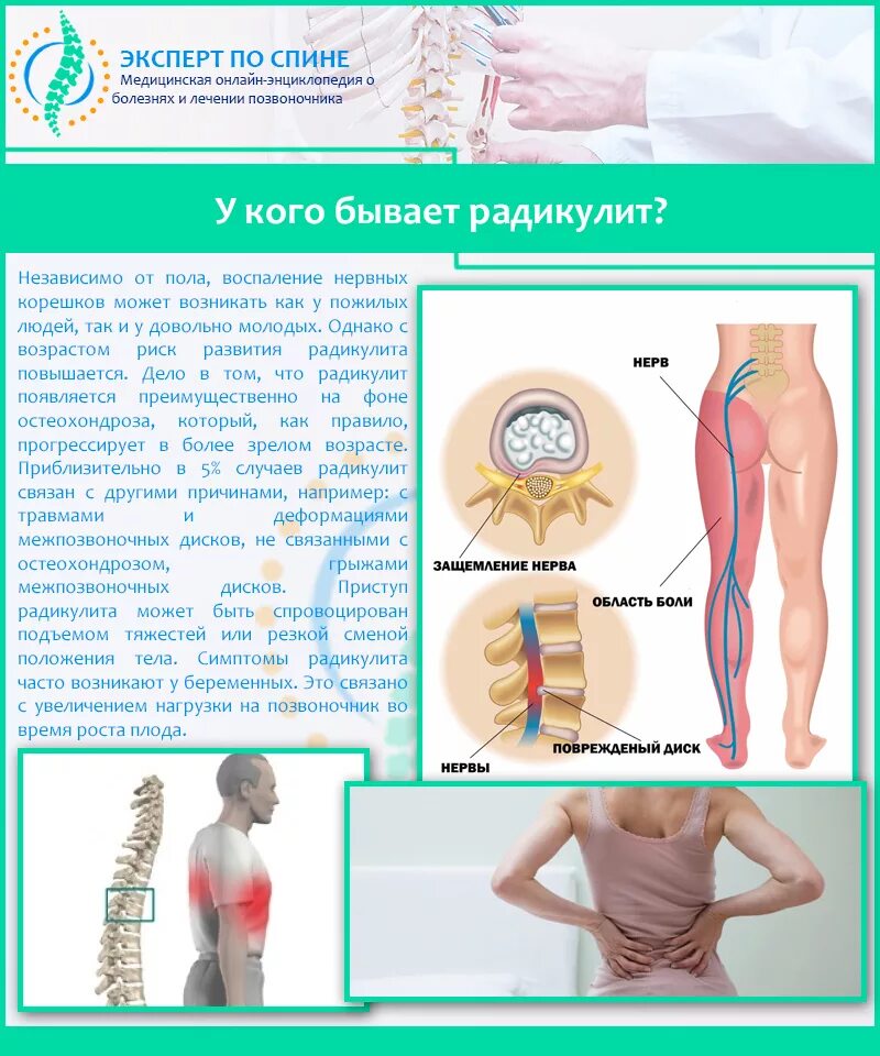 Боль в пояснице при движении у женщин. Заболевание спины поясница. Радикулит поясничный. Пояснично-крестцовый радикулит.
