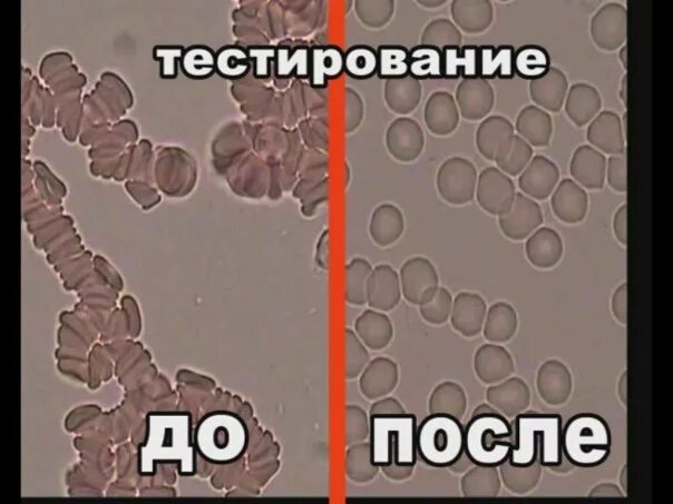 Тест капля крови. Капля крови на темнопольном микроскопе. Кровь в темнопольном микроскопе. Гемосканирование живой капли крови. Диагностика по капле крови.