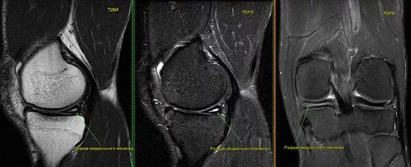 Повреждение мениска коленного сустава мрт. Разрыв медиального мениска мрт снимок. Повреждение заднего рога медиального мениска Stoller 2. Мрт коленного сустава разрыв мениска. Повреждение переднего рога