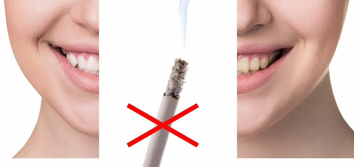 Курить после лечения зуба. Зубы курильщика и здорового человека.