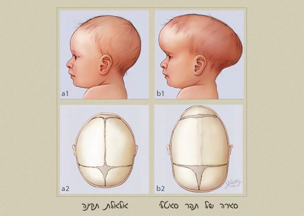 Форма головы младенца норма. Яйцевидная форма головы у новорожденного. Долихоцефалическая форма головы новорожденного. Форма головы у грудничка 4 месяца норма.