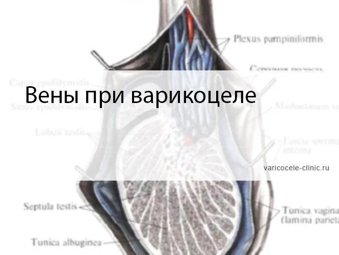 Варикоцеле мошонки стадии 2. Варикоцеле у мужчин 2 степени. Почечная венография варикоцеле. Варикоцеле мошонки стадии 2. Варикоцеле расширение вен.