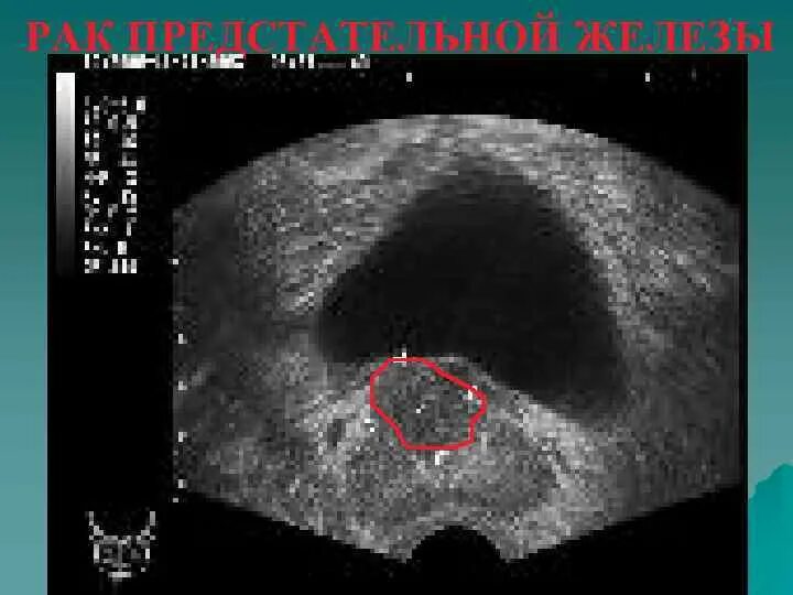 Дгпж узи. Аденома предстательной железы на УЗИ. Трансректальное УЗИ предстательной железы. УЗИ трузи предстательной железы. Гиперплазия простаты УЗИ.