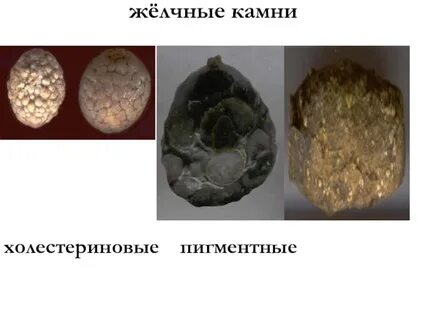 Растворение камней