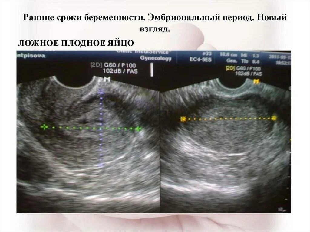 Матка в мм при беременности. УЗИ матки измерения размеров. УЗИ по беременности на ранних сроках. УЗИ измерение размеров матки по УЗИ.