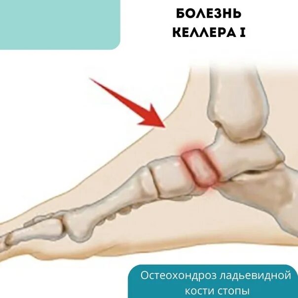 Остеохондропатия Келлера 2. Остеохондропатия ладьевидной кости стопы. Болезнь келлера что это такое
