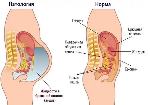 Асцит прокол брюшной полости. Скопление жидкости в брюшной полости (асцит). FCF[BWBN. Откачивание жидкости в брюшной полости.