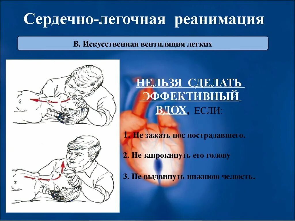 Алгоритм сердечно легочной реанимации (30:2). Сердечнотлегочная реанимация. Сердечно-легочная реанимация (СЛР). При проведении сердечно легочной реанимации у взрослого. Этапы реанимационных мероприятий