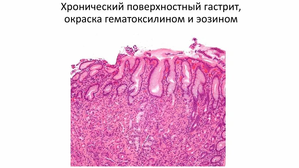 Атрофический гастрит гистология. Желудок хронический гастрит гистология. Атрофический гастрит патанатомия. Хронический атрофический гастрит гистология. Гастрит 2 стадии