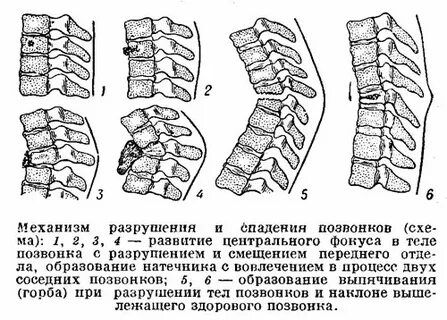 Разрушение позвоночника