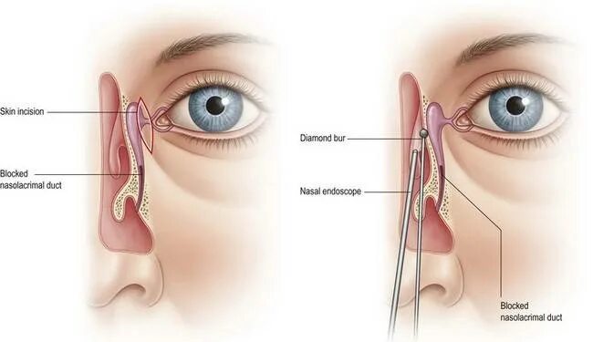 Как прочистить слезные каналы. Эндоназальная дакриоцисториностомия. Трансканаликулярная дакриоцисториностомия. Эндоскопическая дакриоцисториностомия. Операция дакриоцисториностомия.