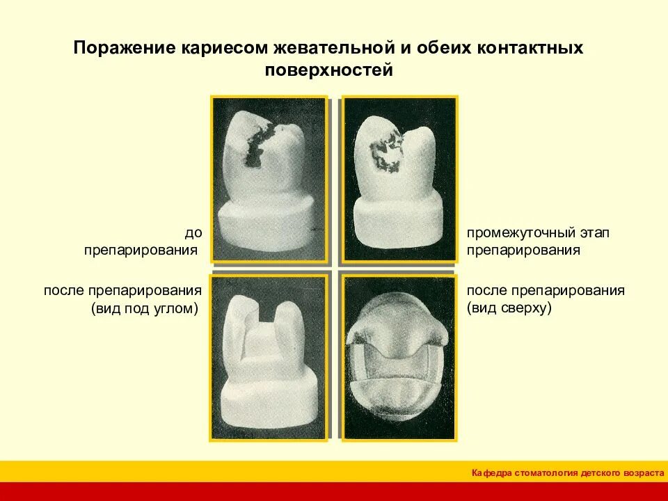Препарирование полостей по блэку. Кариес контактных поверхностей по блеку. этапы препарирования кариозных полостей. препарирование кариозных полостей по блэку.