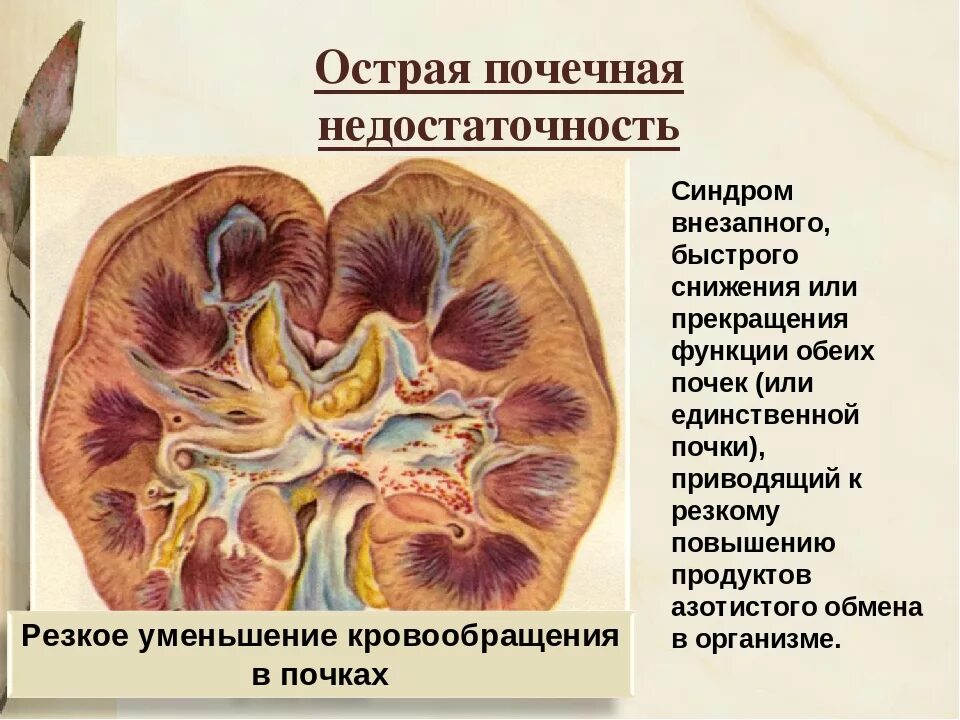 Острые почечные заболевания. Ренальная острая почечная недостаточность. Острая почечная недостаточность почка. Острая и хроническая почечная недостаточность. Почеченач недостатоочь.