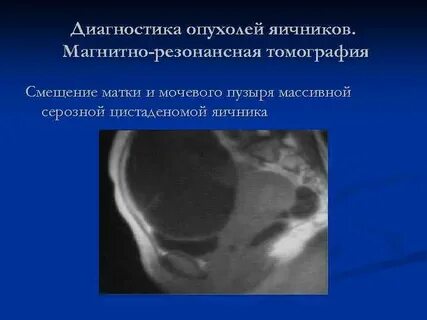 Кисты яичников клинические рекомендации 2023