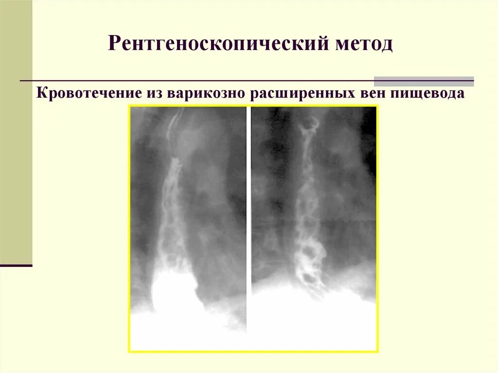 Лечение варикозных вен пищевода