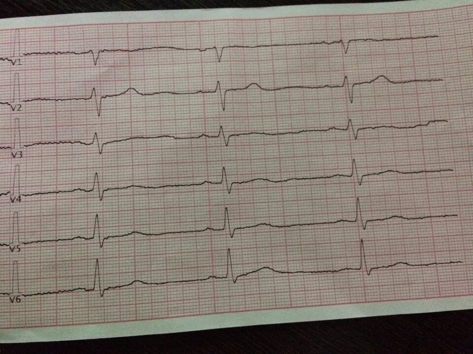 ЭКГ электрокардиограмма сердца. ЭКГ патологии. Нормальная кардиограмма сердца. ЭКГ больного сердца. Экг сочи