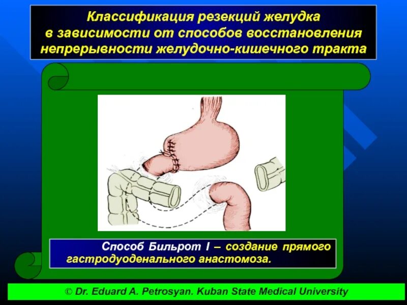 Последствия операции желудка. Классификация операций на желудке. Резекция желудка классификация. Классификация операций на желудке и кишечнике.