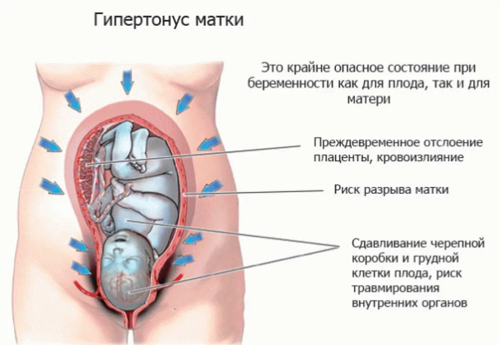 Тонус матки живот. Гипертонус матки при беременности 2 триместр узи. тонус матки при беременности 3 триместр. при тонусе матки при беременности. гипертонус живота при беременности.