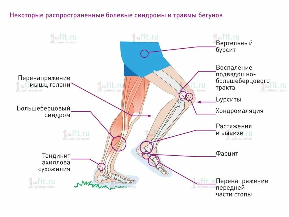 Части подов. Синдром илиотибиального тракта. Ноет нога ниже колена сбоку с внешней стороны. Подвздошно большеберцовый тракт. Болит колено после бега с внутренней стороны сбоку.