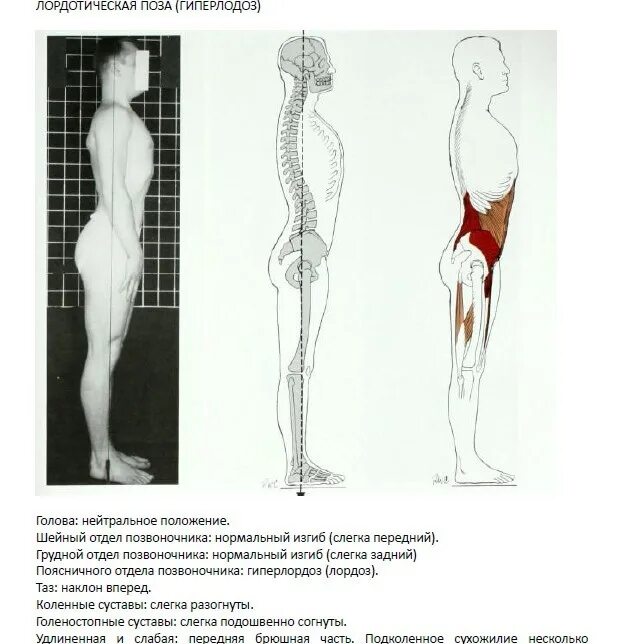 Гиперлордоз поясничного отдела мышцы. Паралитический гиперлордоз. Гиперлордоз таза. Мышцы при гиперлордозе.