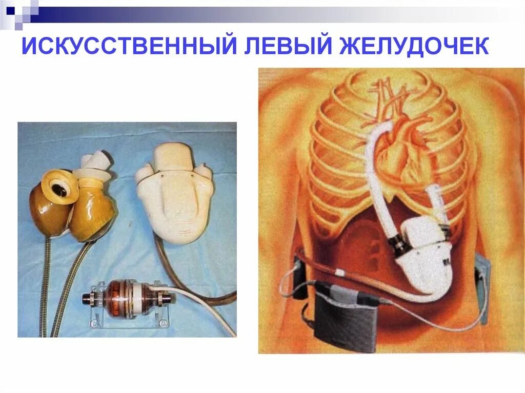 Искусственный левый желудочек. Искусственный левый желудочек сердца. Имплантация искусственного желудочка сердца. Имплантация искусственного левого желудочка.