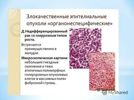Эпителиальные опухоли