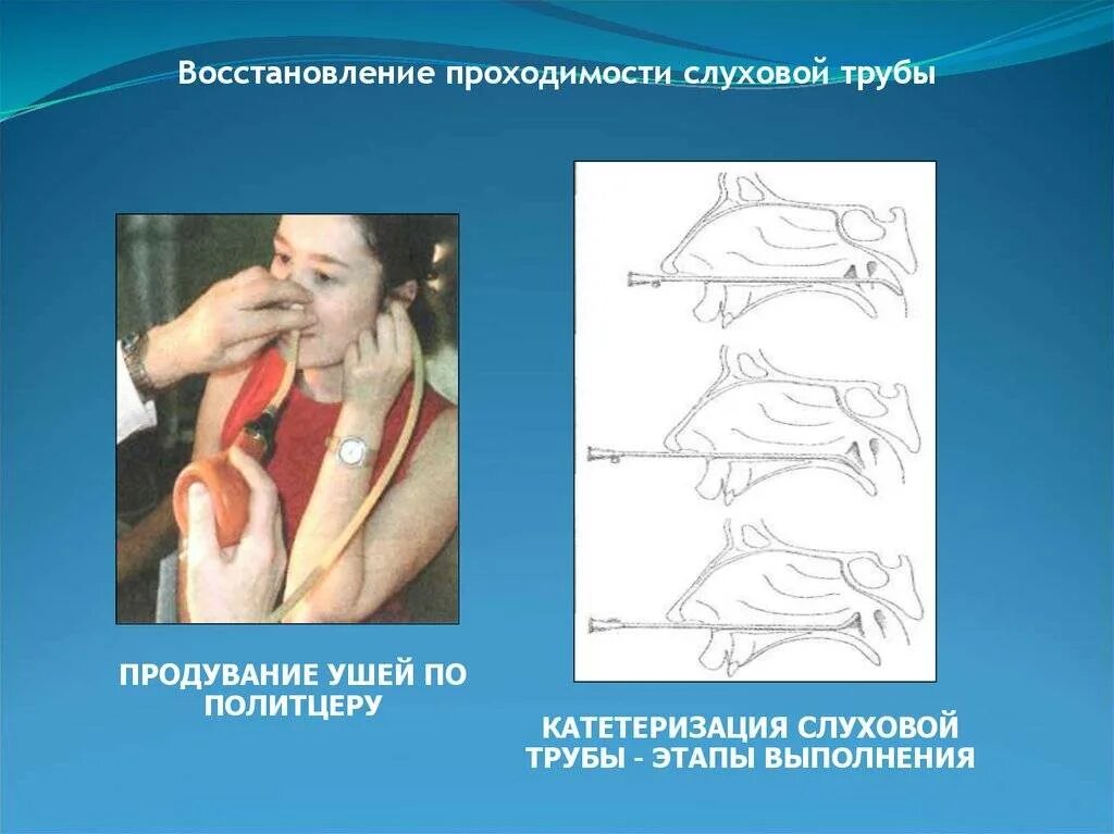 Процедура пароход. Продувание слуховых труб по методу Политцера. Катетеризация слуховой трубы. Продувание ушей Политцеру. Исследование проводимости слуховой трубы.