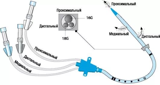 строение мочевого катетера фолея. проксимальный конецкатетора. проксимальный конец катетера это. дистальный конец катетера фолея. проксимальный отдел катетера фолея.